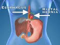 Understanding Heartburn (Heartburn #1)