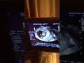 Click here to watch this video Ultrasound 10 Weeks 5 Days - Dancing Baby 360 Degrees Turn!!!