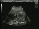 Victoria 24 semanas de gestación Victoria 24 semanas de gestación