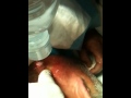 Pimple pop part 5