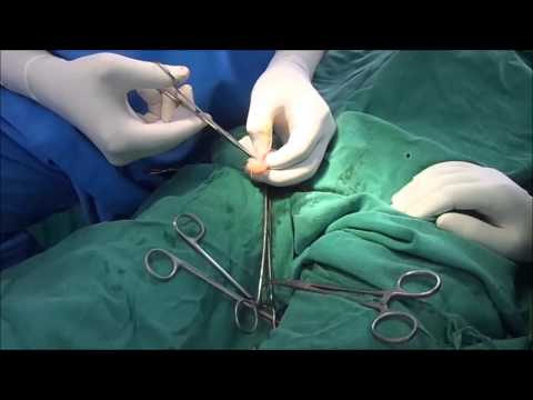 how to cure epididymal cyst