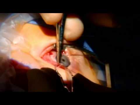 how to treat nystagmus