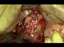 implant dental video preview 05