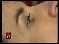 Fraxel Laser Skin Rejuvenation - Dr. Roger Bassin -Pt 1 of 2