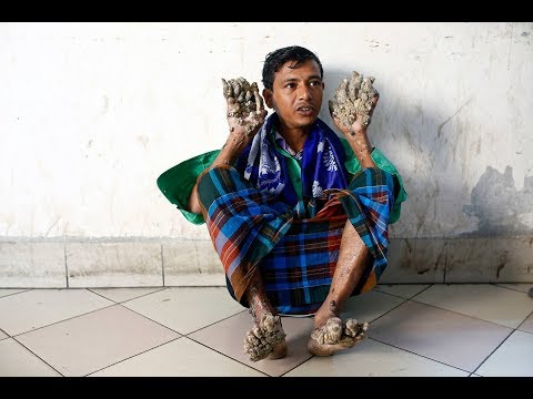 Abul Bajandar, Baum-Mann aus Bangladesch, hofft auf n ...