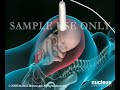catalog.nucleusinc.com Un parto por cesárea, generalmente conocido como 