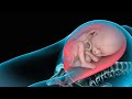 Parto por cesárea - 3D animación de médico