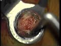 Laminectomy portion of my back surgery Laminectomy portion of my back surgery