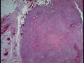 Epithelioid Sarcoma