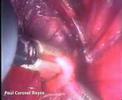 Tiroidectomía Videoendoscópica en Caninos