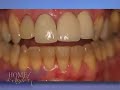 Power Bleaching - Whiter Teeth in Atlanta Georgia Power Bleaching - Whiter Teeth in Atlanta Georgia