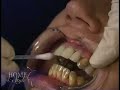 Extreme Makeover - Power Bleaching - Whiter Teeth in Atlanta Georgia