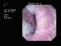 endoscopy endoscopy