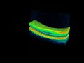 Topcon 3D OCT - Macular Hole Macular Hole