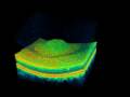 Topcon 3D OCT - Macular Hole