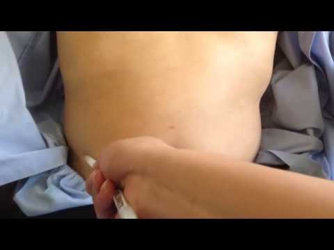 how to perform abdominal reflex