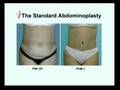 Antonio M. Carbonell, MD, FICS - Body Contouring