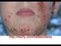 Pictures of Eczema - Infant Children Adult