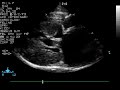 Echocardiogram (long-axis) from a cat with severe hypertrophic cardiomyopathy. There is left atrial enlargement and regions of end-systolic cavity obliteration. The walls of the left ventricle are severely thickened and a very large papillary muscle can be seen.