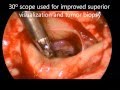 Endoscopic Endonasal Approach for Biopsy of Suprasellar Mass