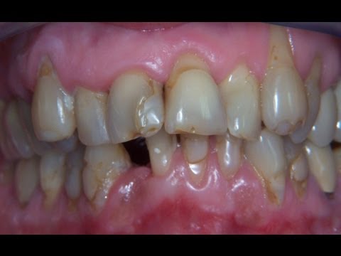 gencive - Pour la première fois une vraie vidéo montrant la complète transformation des dents et de la gencive avec des facettes dentaires.http://dr-nahon-jacques.chir...