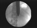 Sword Swallowing X-ray Fluroscopy