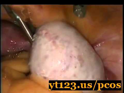 how to treat pcos at home