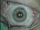 Refractive Surgery (LASIK) Refractive Surgery (LASIK)