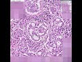 Histopathology Lung--Adenocarcinoma