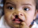 Operation Smile Final Mile Promo Operation Smile Final Mile Promo