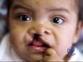 Operation Smile Final Mile Promo