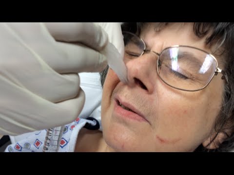 how to treat epistaxis