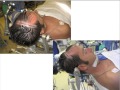 Interhemispheric transcallosal route for resection of anterior third ventricular lesions
