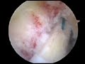 Cirurgia LCA Cirurgia LCA