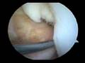 Cirurgia LCA
