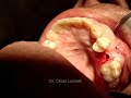 Dental Implant. Flapless Surgery and Immediate Loading