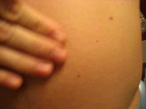 belly distension