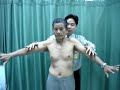 Jobe test Supraspinatus tear เอ็นหัวไหล่ฉีก