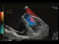 videos de TEE PLSVC