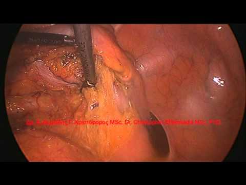 laparoscopic sigmoidectomy