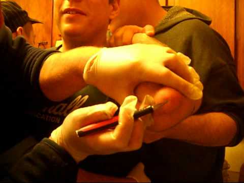 how to drain bursitis