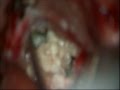 Brain tumor-Bilateral frontal epidermoid-microsurgical removal-dr suresh dugani/HUBLI/KARNATAK/INDIA