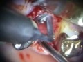 Implant Microsurgery: Removal and Replacement