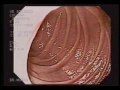 Endoscopia Realizada a Luciana Sandoval El Salvador parte 2