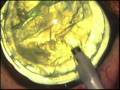 videos de Cataract Surgery Dog
