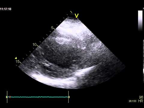 how to treat lv thrombus