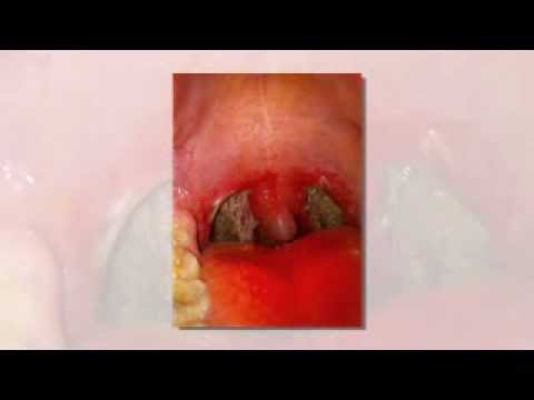 how to treat uvulitis