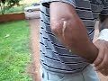 Braço INFLAMADO