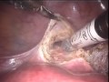 da Vinci S / Robotic Hysterectomy by M. Patrick Lowe MD