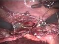 da Vinci S / Robotic Hysterectomy by M. Patrick Lowe MD